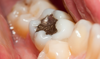 amalgam filling in a tooth