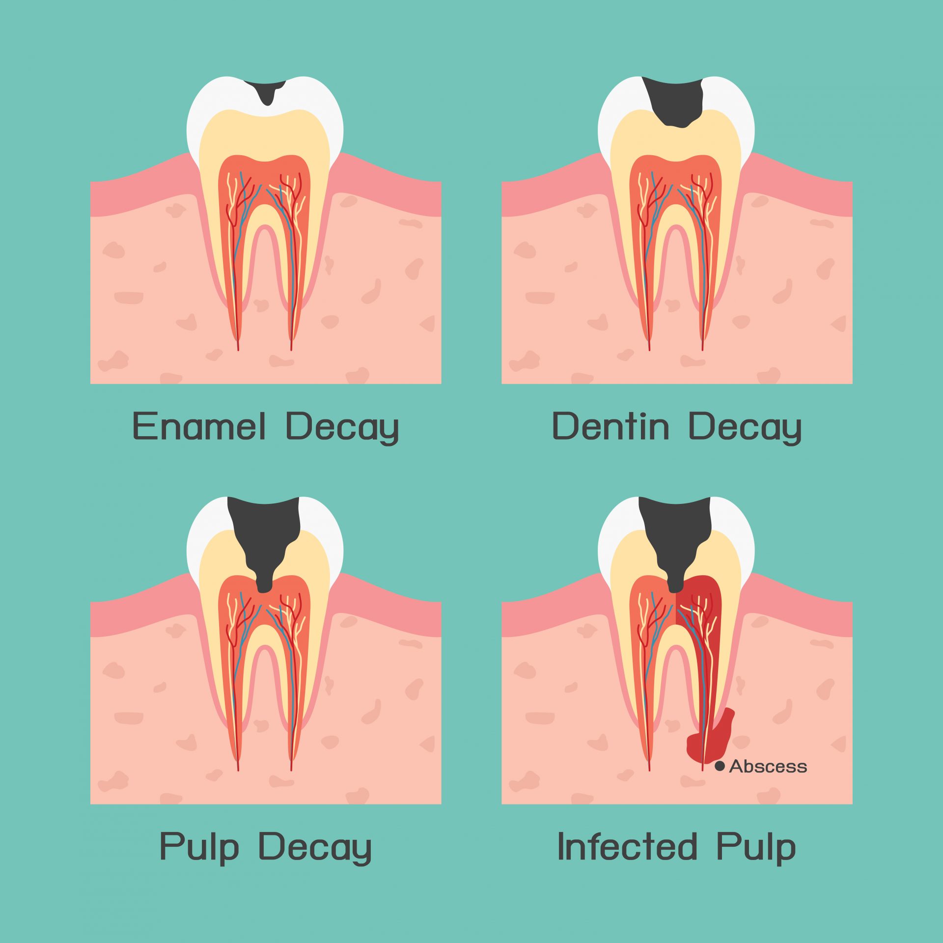 Diagram of enamel decay, dentin decay, pulp decay and an infected pulp