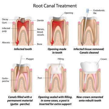 Root Canal Treatment process diagram