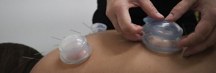 acupuncture and cupping technique being used together