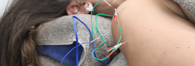 Electromagnetic stimulation with acupuncture needles
