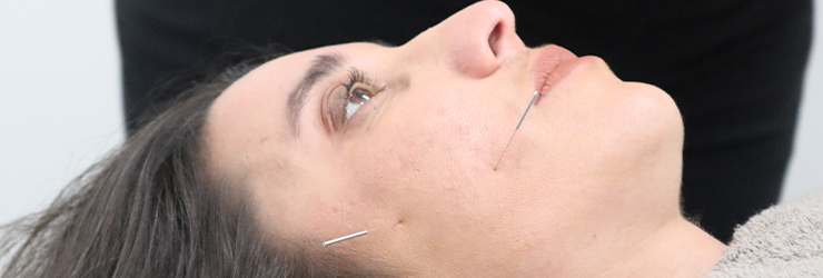 Acupuncture needles relieving TMJ jaw muscles